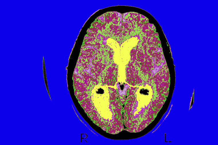 A brain scan of a patient affected by Alzheimers disease.