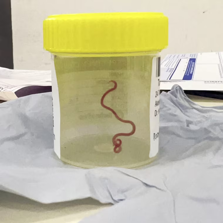 This undated photo supplied by Canberra Health Services, shows a parasite in a specimen jar at a Canberra hospital in Australia.