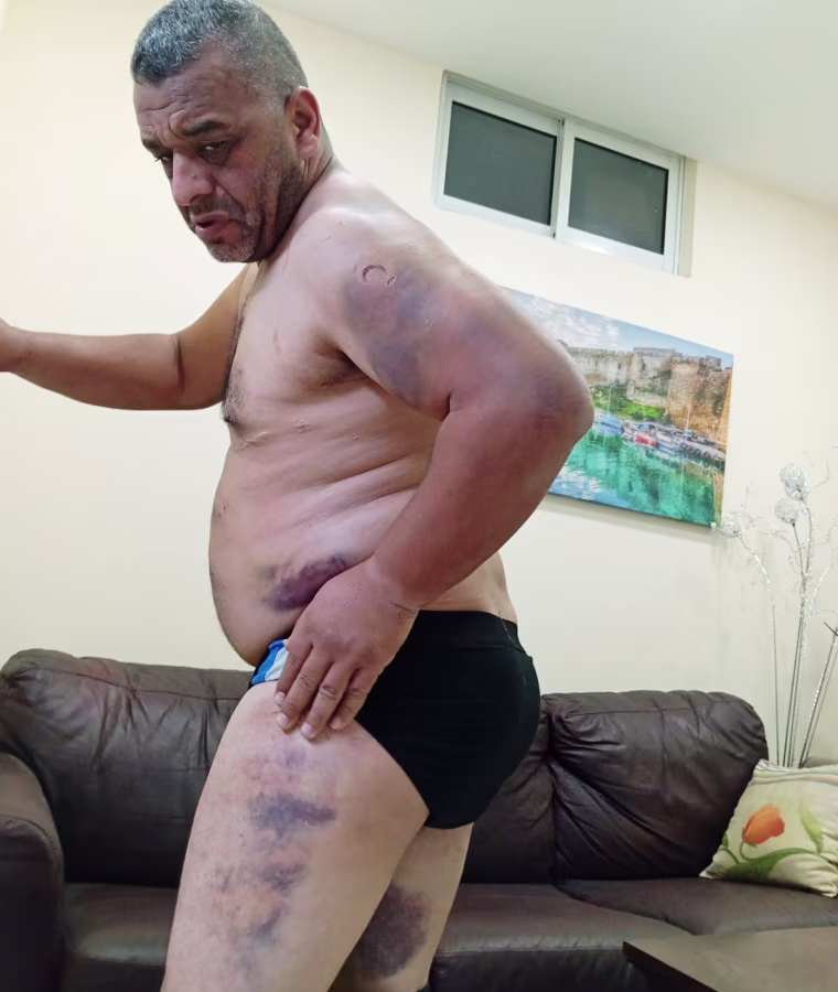 Mohamad Mattar shows bruises on his legs, arm and torso that he said are the result of a beating from Israeli soldiers and settlers in the occupied West Bank.