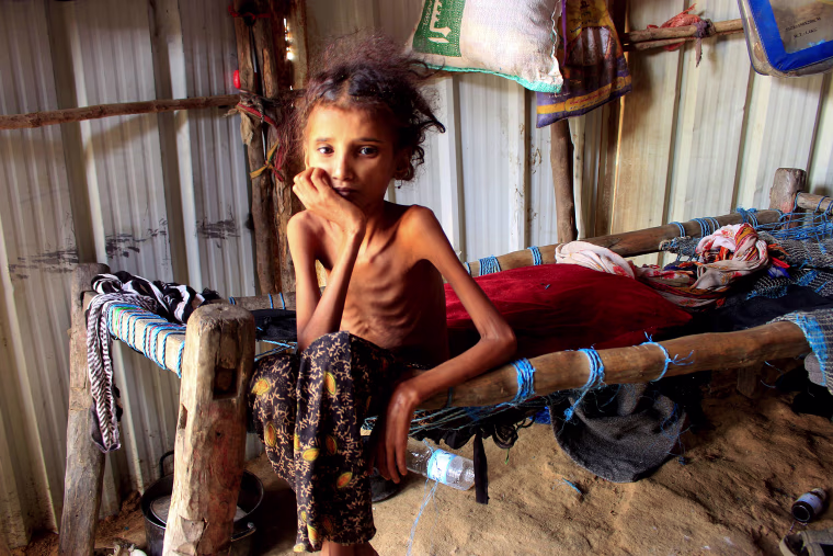 Image: Yemeni 10-year-old girl Ahmadia Abdo, who weighs ten kilograms due to acute malnutrition, sits on her bed at a camp for the internally displaced in the northern Hajjah Governorate, on Jan. 23, 2021.