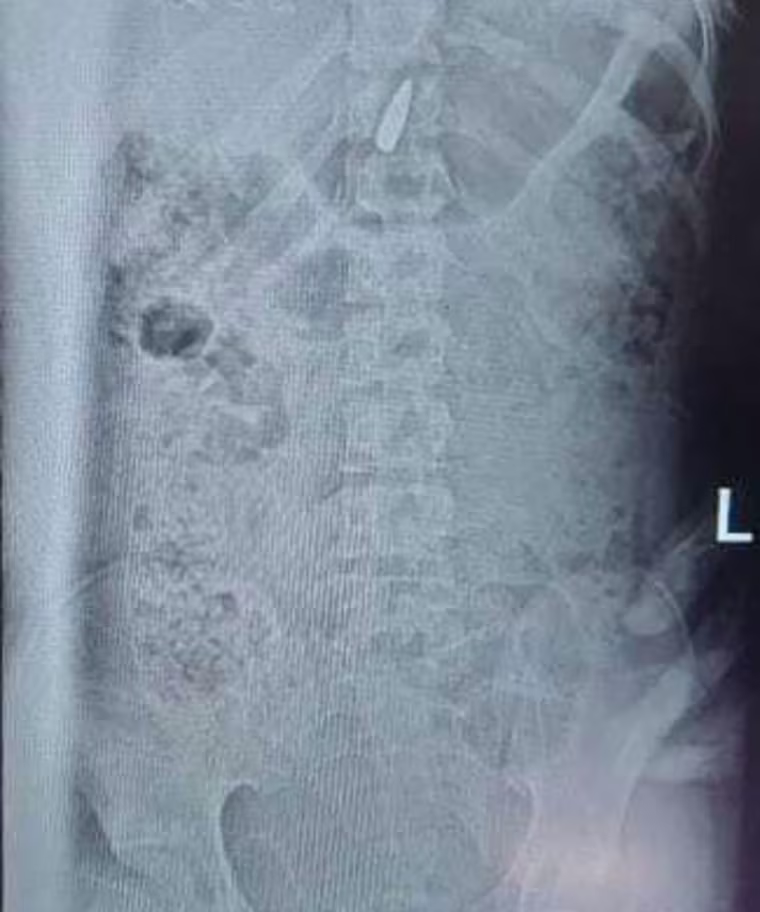 An X-ray showing the bullet in Salma Alyazji's spinal column.
