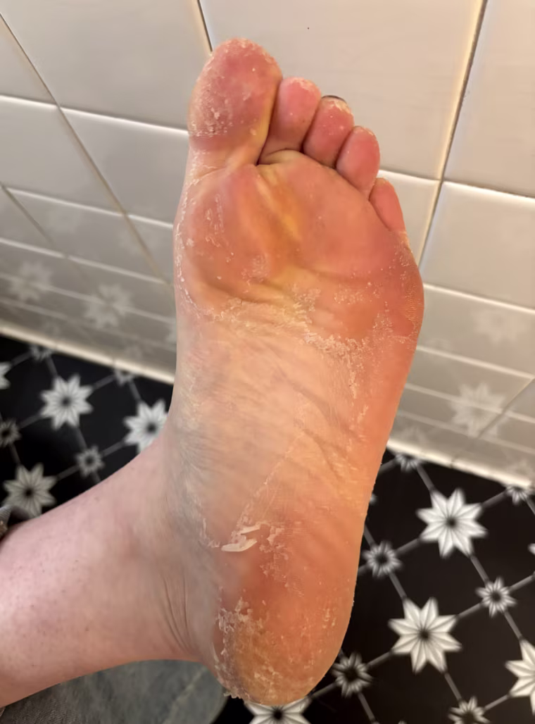 One staffer’s left foot is peeling from her toes to the outside of her feet and concludes at her heels.