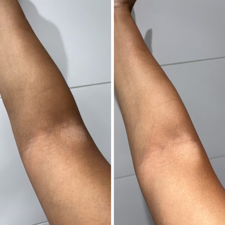 The left image shows dry, eczema-prone skin with a current flareup and without any moisturizer. The right image shows the same eczema-prone skin, but after the Vanicream Moisturizing Skin Cream was applied.