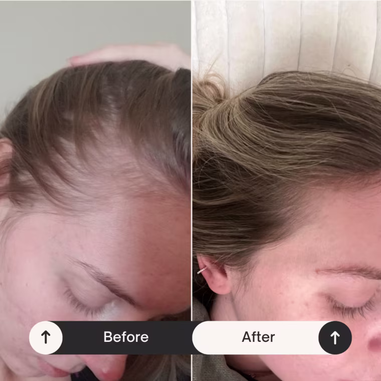 Woman showing hair growth before and after.