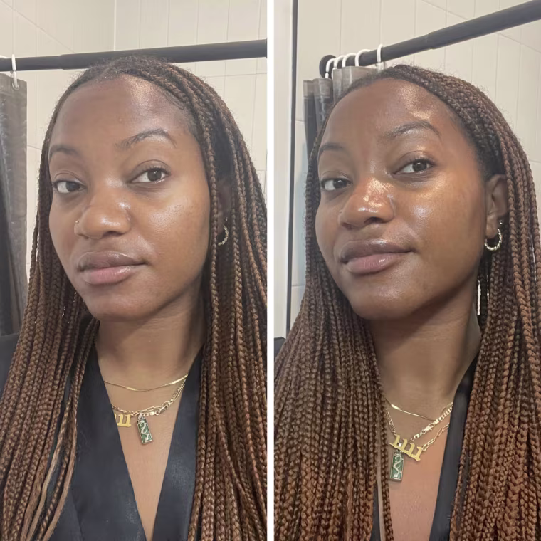 Side by side image of woman before and after applying hyaluronic acid serum.