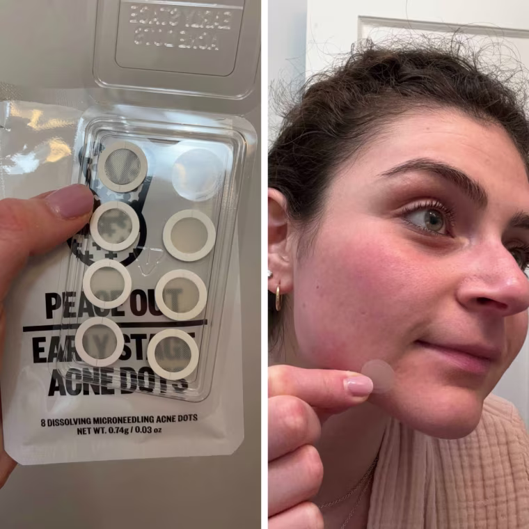 NBC Select Associate Updates Editor Zoe Malin uses Peace Out's Early Stage Acne Dots to treat her breakouts.
