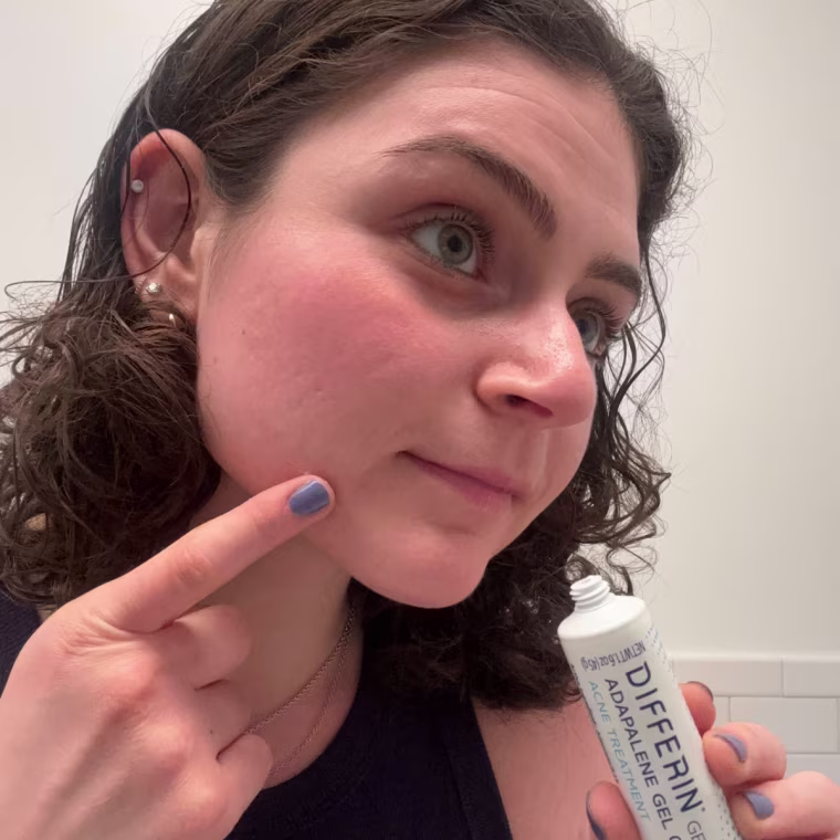 Before being prescribed acne medication, Malin used Differin and saw a dramatic change in her skin.