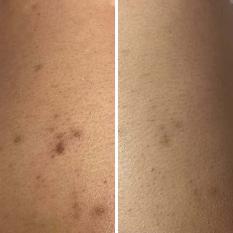 On the left, dark brown reddish scars appear on the outside of the left thigh. On the right, an image of the same scars appears eight weeks later; this time, they appear to be light brown and faded.