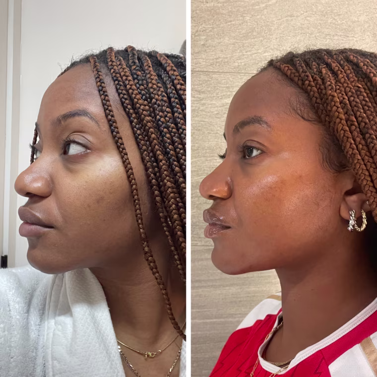 On the left, a woman displays acne scars on her left cheek. The scars appear two to three shades darker than her natural darker complexion. On the right, an image of the same acne scars appear eight weeks later; this time, they are lighter and blend more into her skin tone.