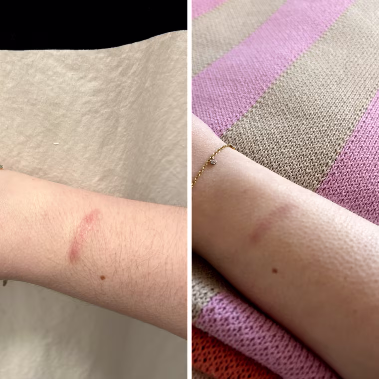Side by side of scar on woman’s arm