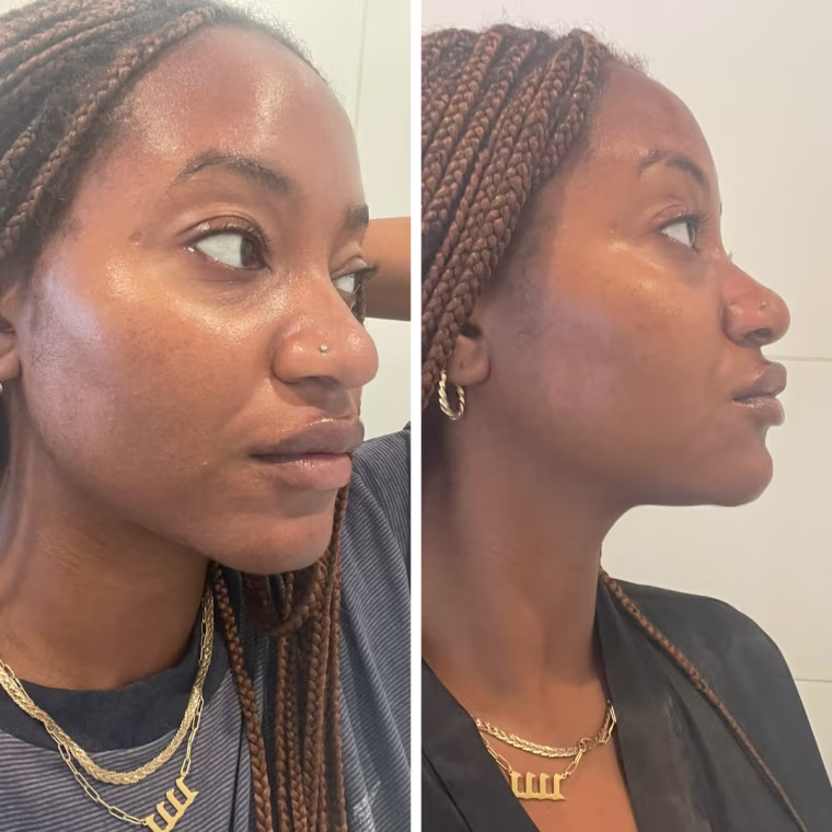 Left: a close-up of one side of Morris’ face before using the mask, showing small patches of texture and small acne flare-ups.
Right: a close-up of one side of Morris’ face after using the mask, with little to no texture or acne.