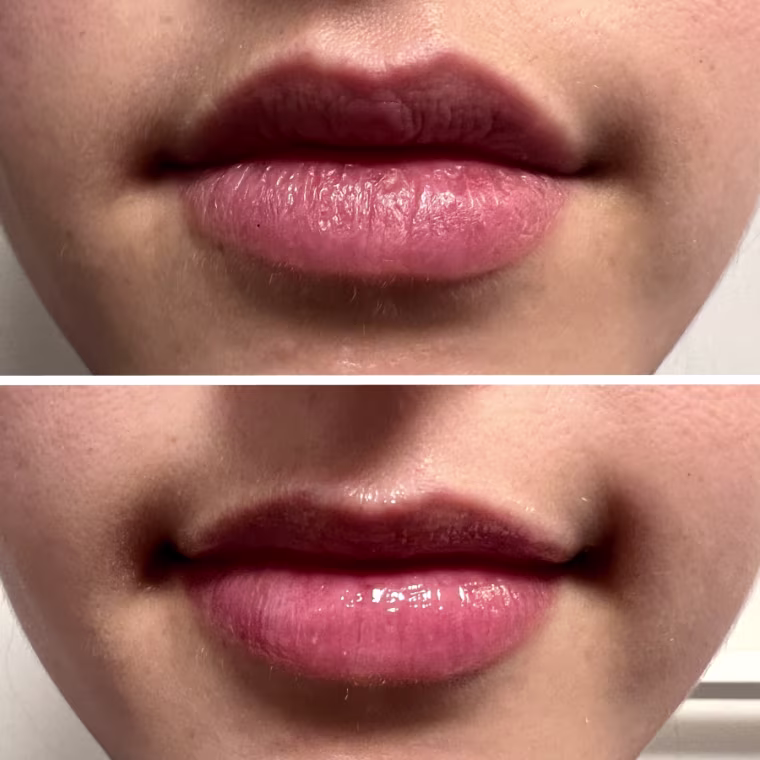 Before and after image of lips before applying Aquaphor lip balm and after
