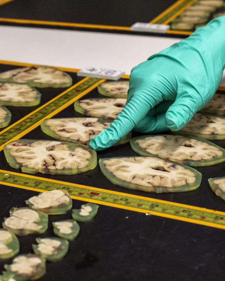 Four-millimeter slices of brain are preserved and embedded in a gel called agarose at Harborview Medical Center in Seattle. Researchers arrange slices of brain in sequences from front to back, so they can identify markers of Alzheimer’s or other neurodegenerative diseases.