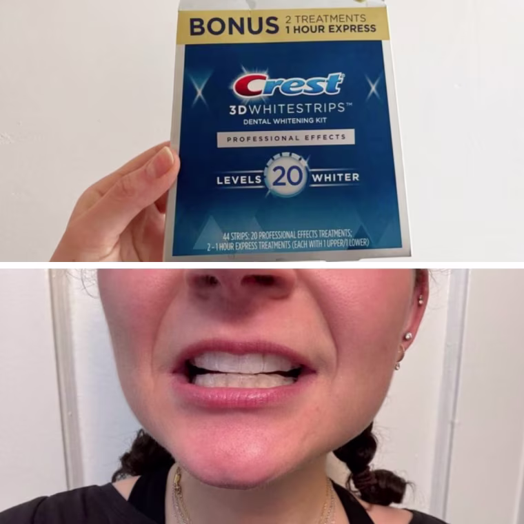 A box of Crest 3D Whitening Strips Professional Effects, top, and a woman wearing the whitening strips on her top and bottom teeth.