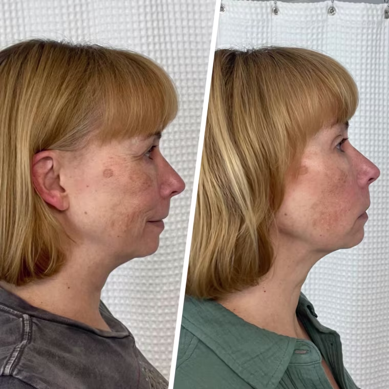 Freelance writer Tanya Edwards before and after using the SickScience Jawline Serum