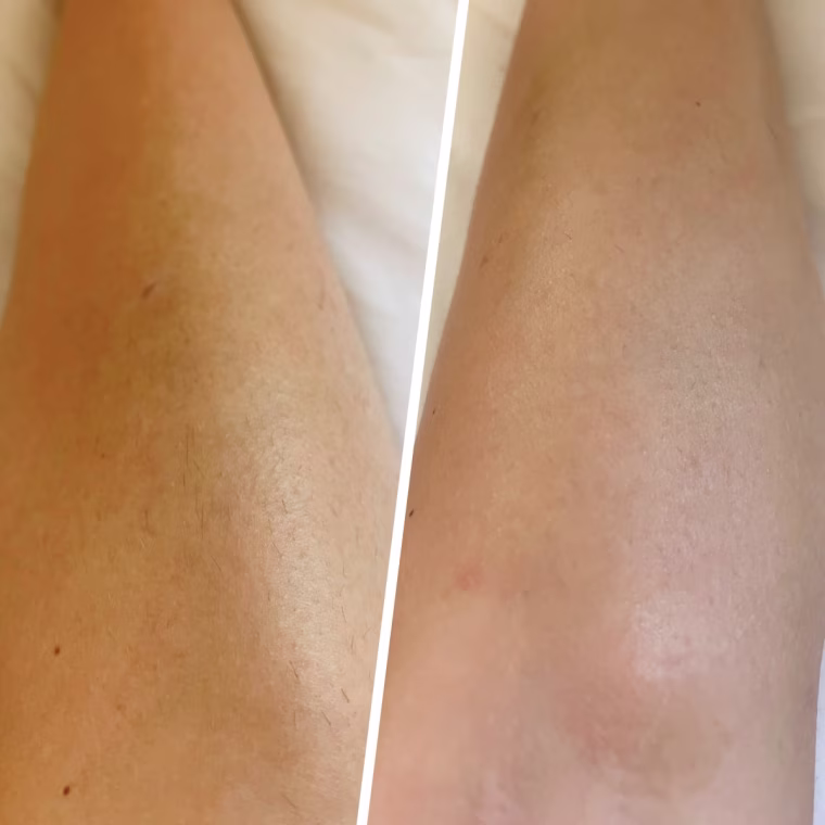 Results before (left) and after (right) using the Nood Flasher for nearly two months.