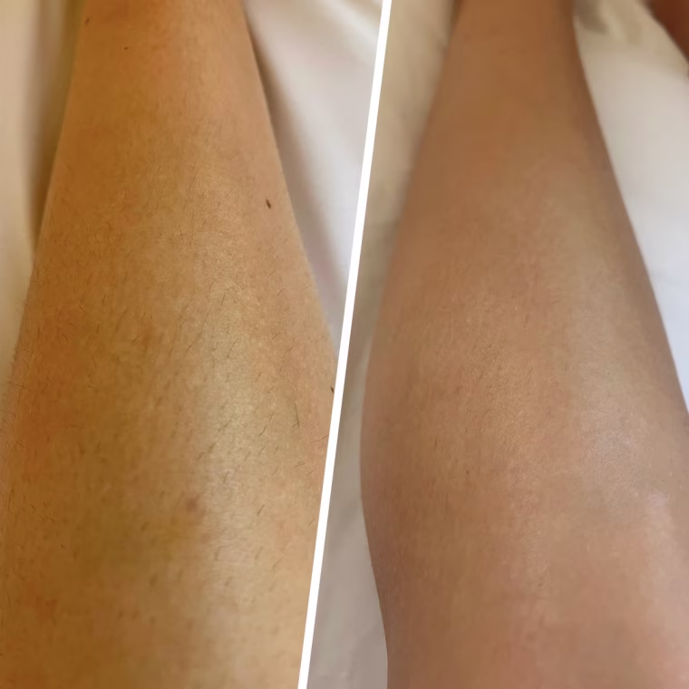 Results before (left) and after (right) using the Ulike Air for nearly two months.