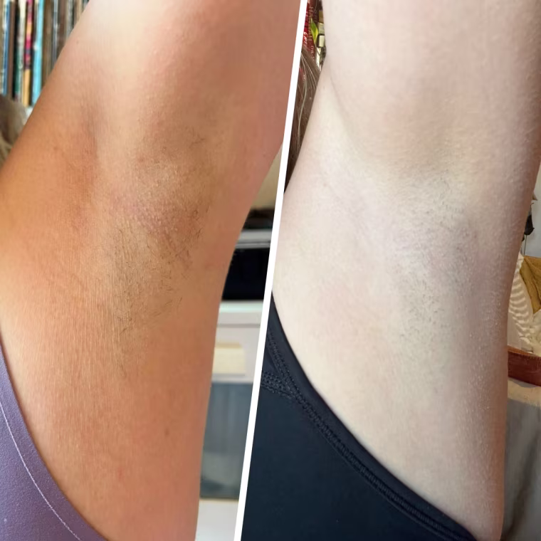 Results before (left) and after (right) using the device for nearly two months.