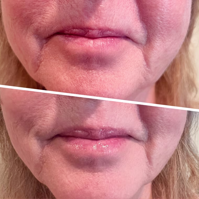 RoC Derm Correxion Lip Volumizer before (top) and after (bottom)