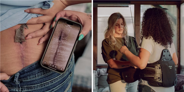 A split composite image of Nala White lifting up her shirt to reveal scars on her back next to a phone showing a photo of said scar, left, and Christine Byers helping Nala White adjust a back brace
