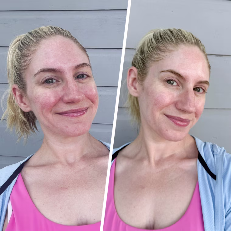 Before and after using the Medicube Salmon PDRN Pink Collagen Jelly Gel Mask.