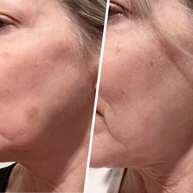 Hero Cosmetics Mighty Patch Micropoint for Dark Spots before and after use.