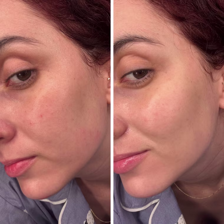Before and after of woman using a Biodance face mask