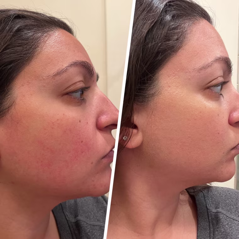 Jillian Gonzales, before and after using the Hero Cosmetics Rescue Balm Red Correct Green Cream.