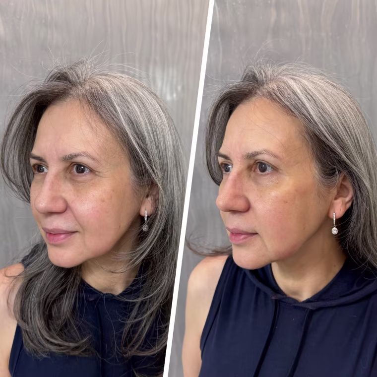 Tester Julia Moon before and after using the Peter Thomas Roth Peptide Skinjection Expression Line Hydra-Gel Patches.