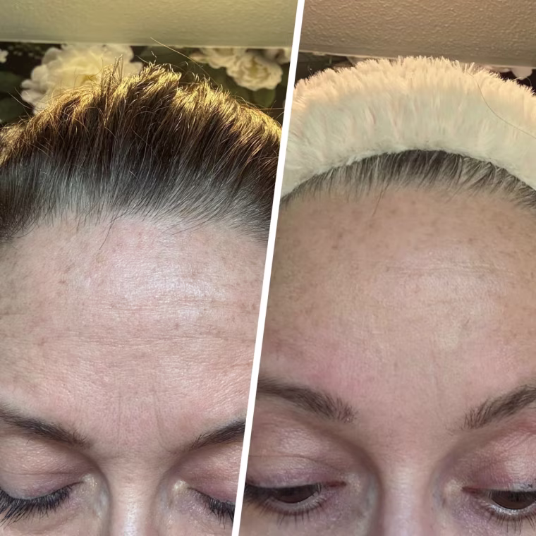 Before and after using the Wrinkles Schminkles patch for three weeks.