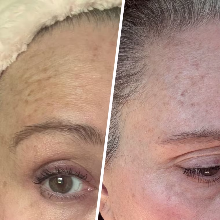 Before and after using the Skin Gym patches on the wrinkles near my temple.