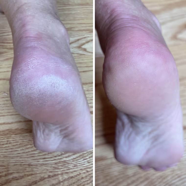 Onyx Professional Foot Mask and Heel Treatment before (left) and after (right) use.