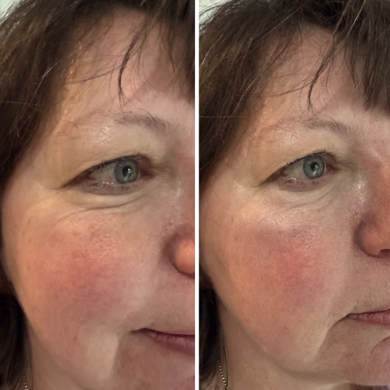 Tula Skin Care Eye Balm Glow & Get It Eye Balm before (left) and after (right) use.