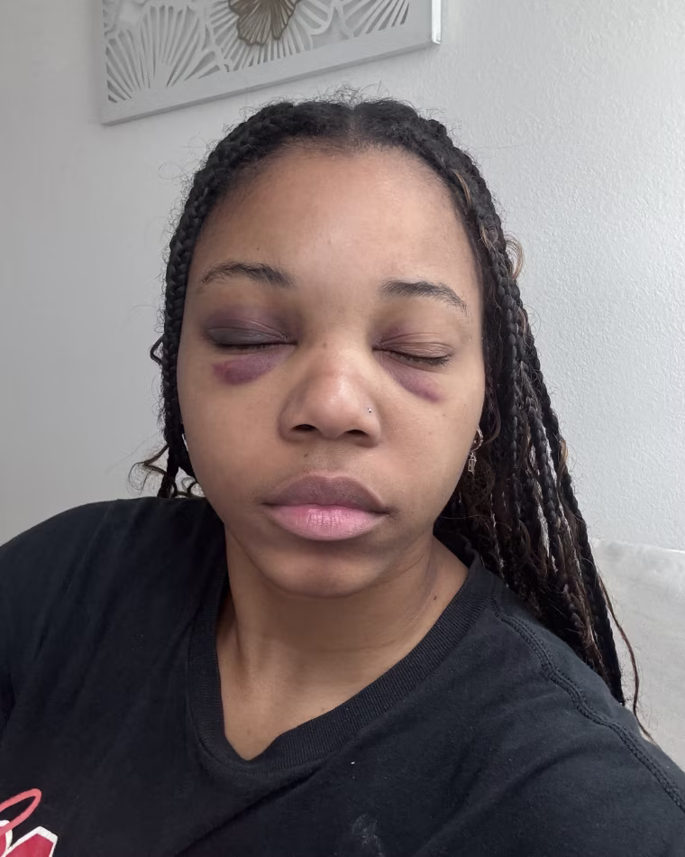 Eryn Bonner facing the camera with her eyes closed to show bruises on her eye lids and on top of her cheeks
