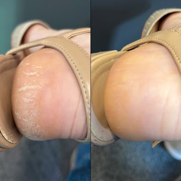 Before and after using the Dr. Scholl's Dry, Cracked Skin Ultra-Hydrating Foot Mask.