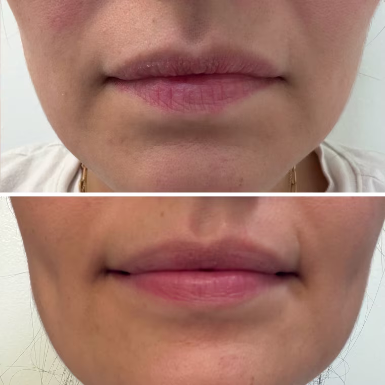 Executive editor Adrianna Brach before (top) and after (bottom) applying the Revision Skincare Youthfull Lip Replenisher.