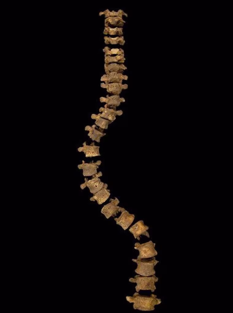 This is the spine of what has been confirmed to belong to King Richard III. It shows the king would've had so-called idiopathic adolescent-onset scoliosis, meaning the cause is unclear though the individual would have developed the disorder after age 10; the curvature would've put pressure on the man's heart and lungs and could've caused pain.