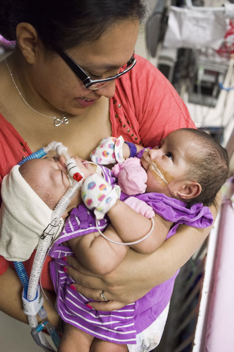 The procedure to separate the twins will involve a 20-to-30-person medical team at the Texas Children's Hospital in Houston.