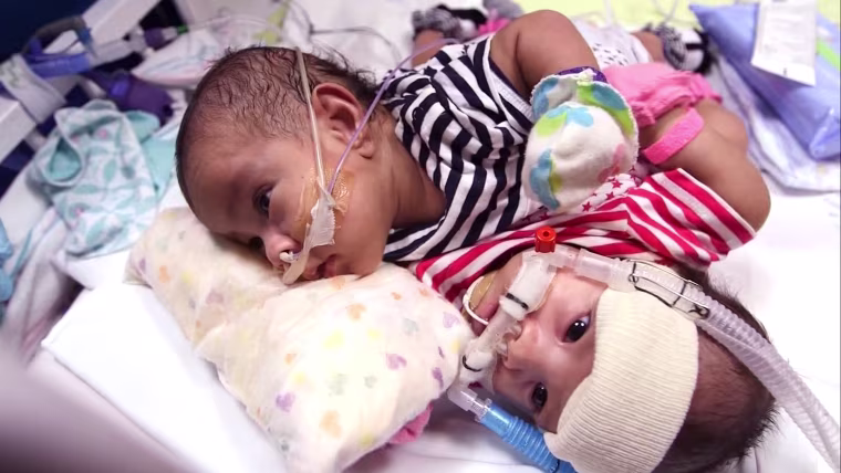 Knatalye Hope and Adeline Faith were born on April 11 sharing a liver, diaphragm, intestines and the lining of the heart known as the pericardial sac.
