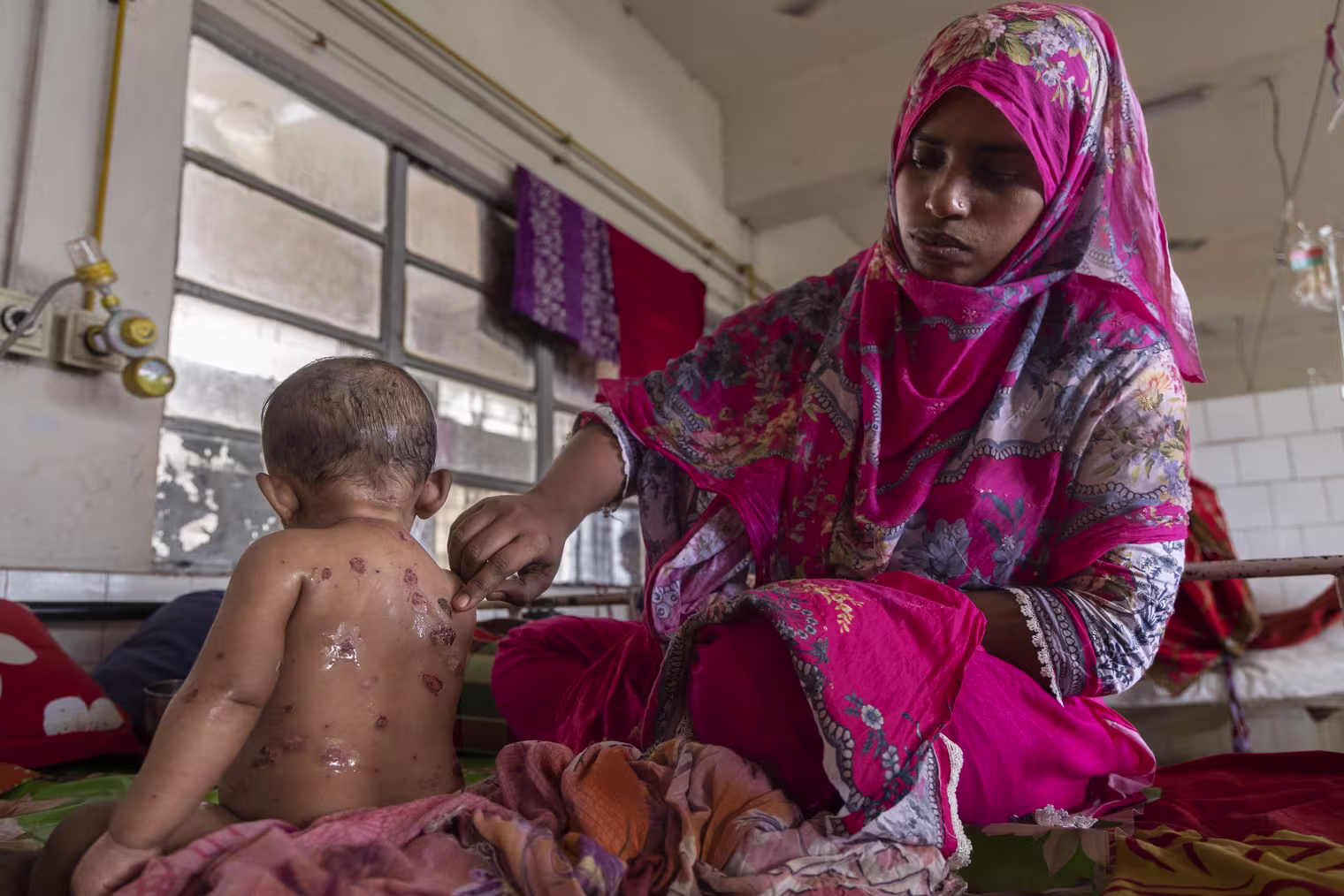 Measles Outbreak In Dhaka