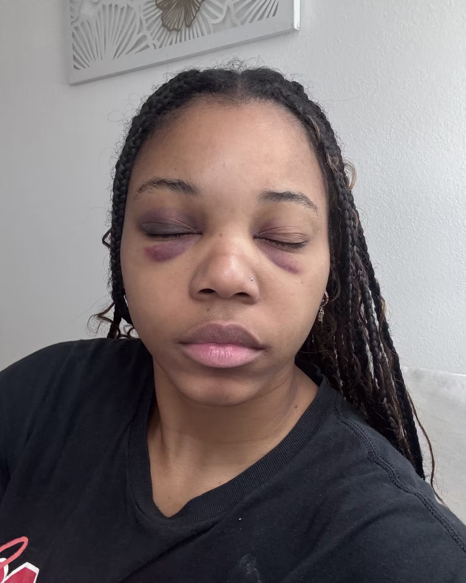 Eryn Bonner facing the camera with her eyes closed to show bruises on her eye lids and on top of her cheeks