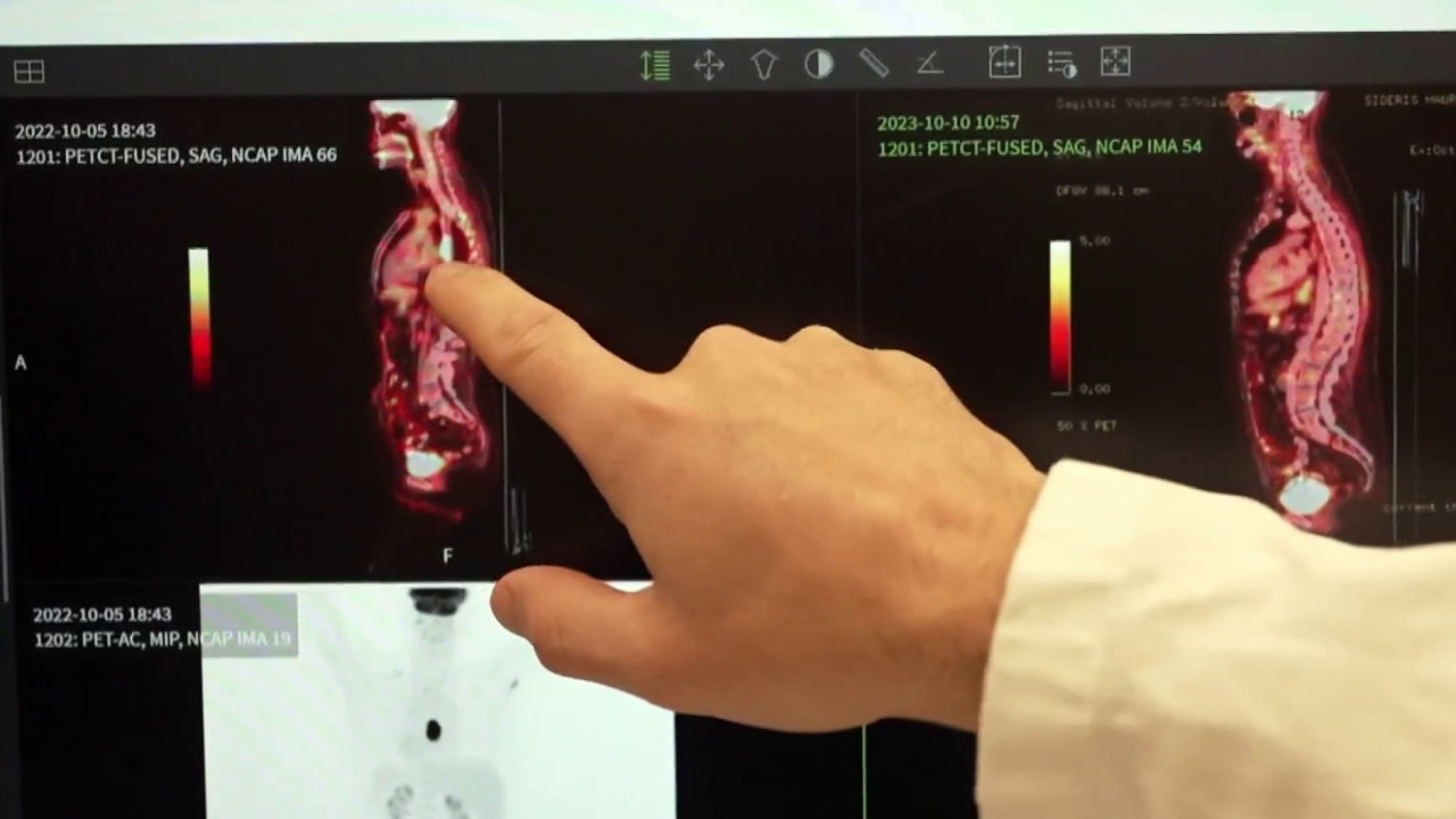 Major breakthrough in cancer treatment