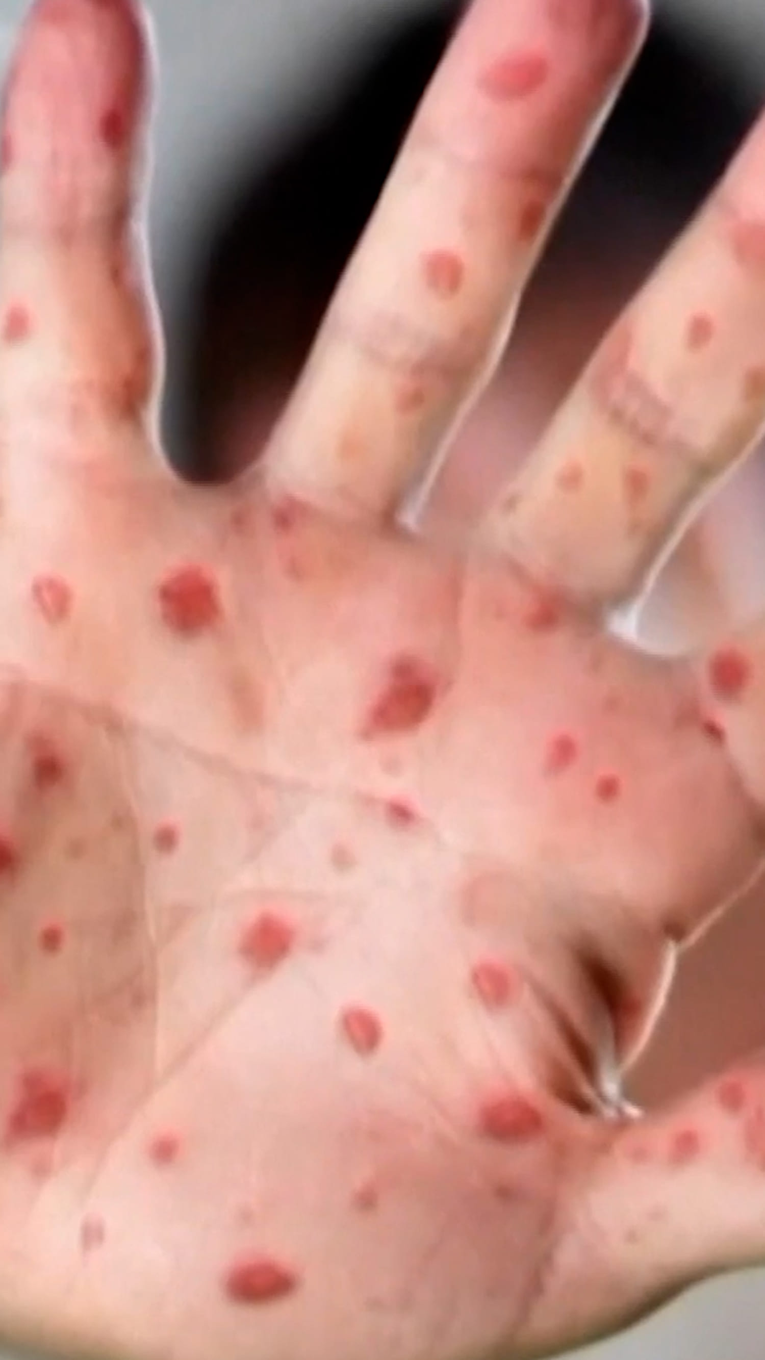 Hundreds of students quarantine amid measles outbreaks