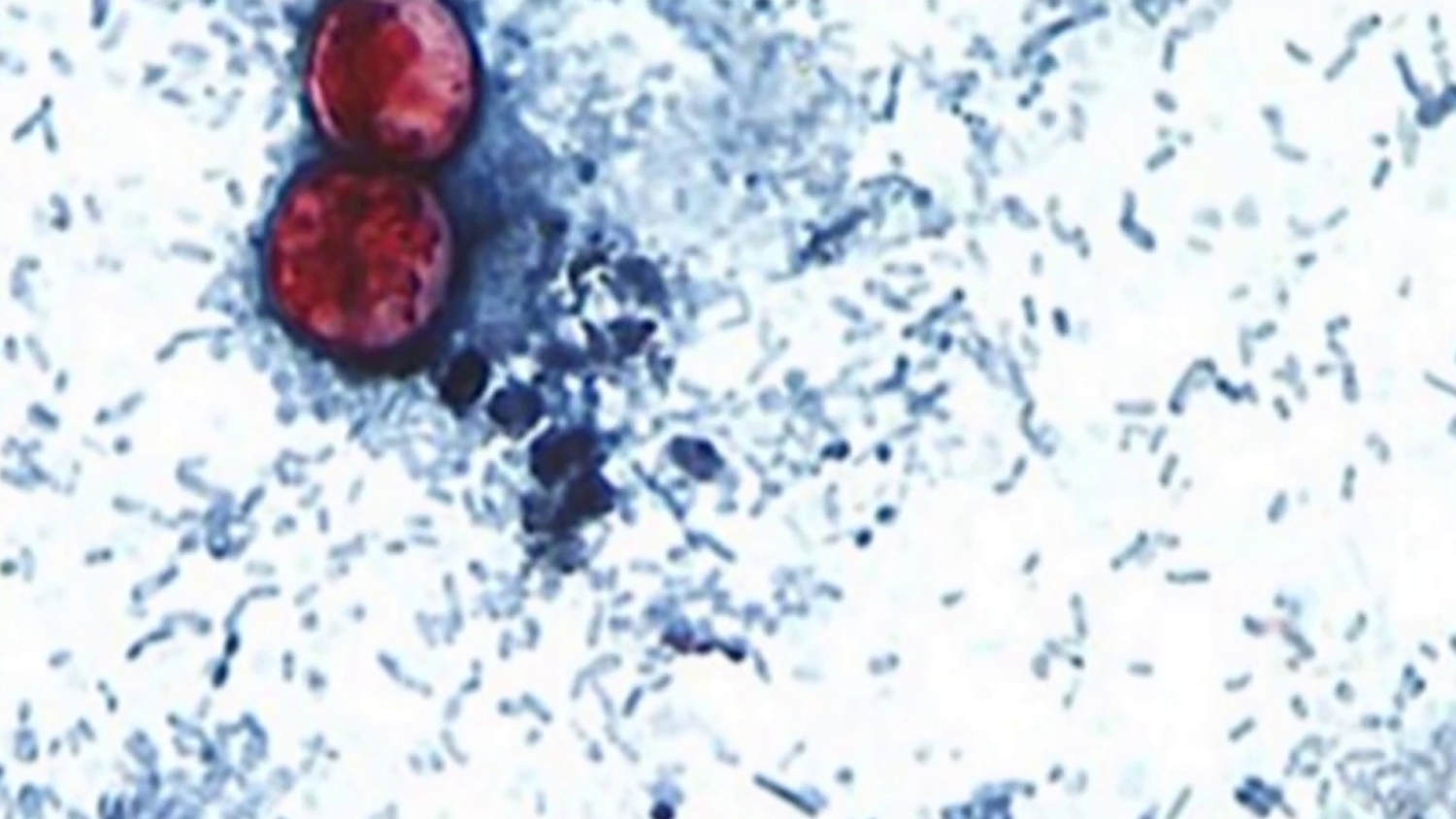 Cases of illness that causes explosive diarrhea on the rise across the U.S.​Cases of illness that causes explosive diarrhea on the rise across the U.S. 