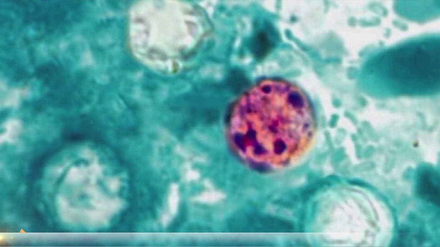 Cyclosporiasis Outbreaks Hits More Than Half of the US