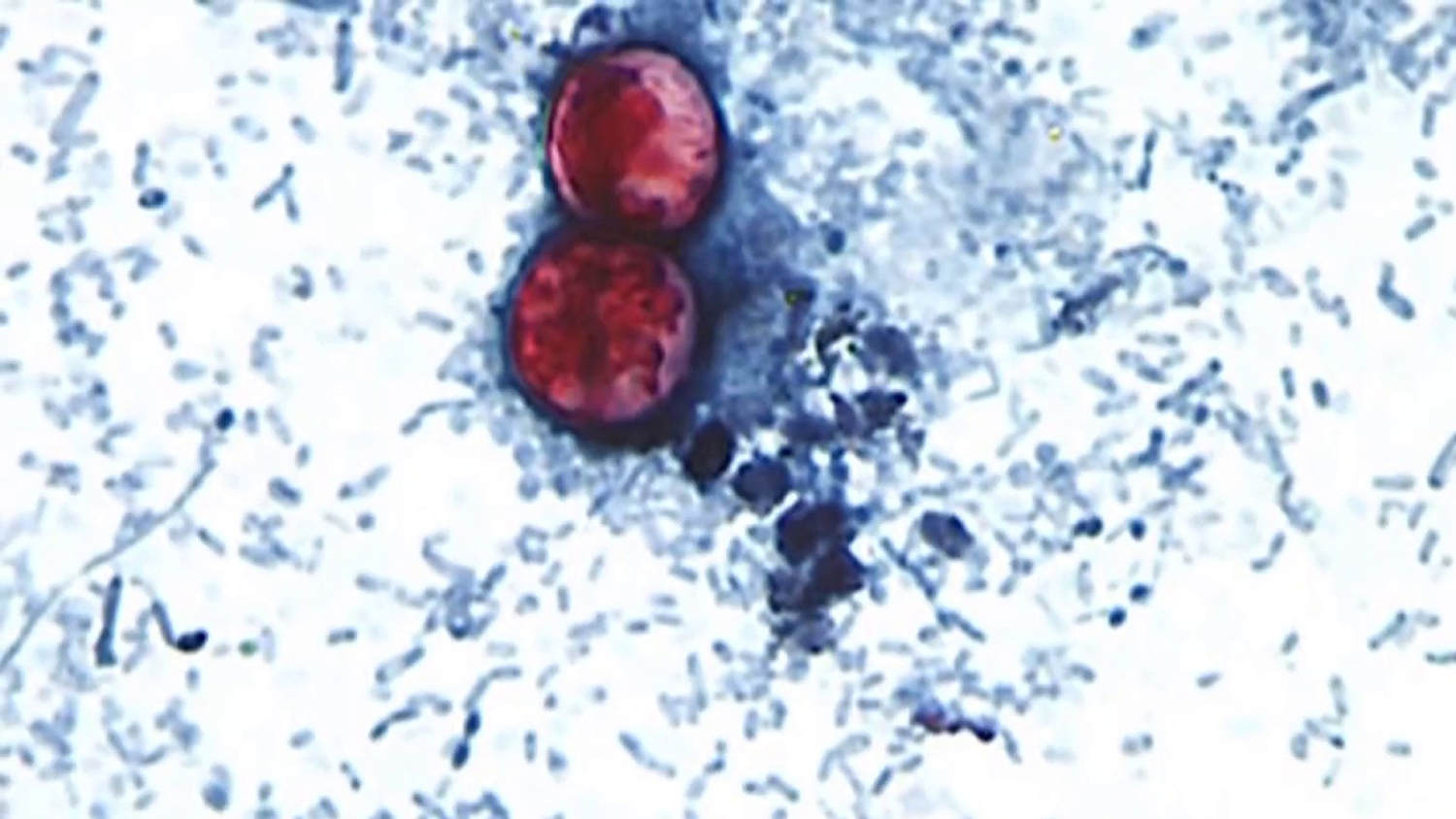 Questions grow over potential impact of budget cuts on response to cyclospora outbreak​Questions grow over potential impact of budget cuts on response to cyclospora outbreak 