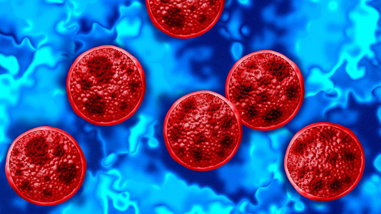 Two Deaths Linked to Cyclosporiasis Outbreak in Michigan​Two Deaths Linked to Cyclosporiasis Outbreak in Michigan 