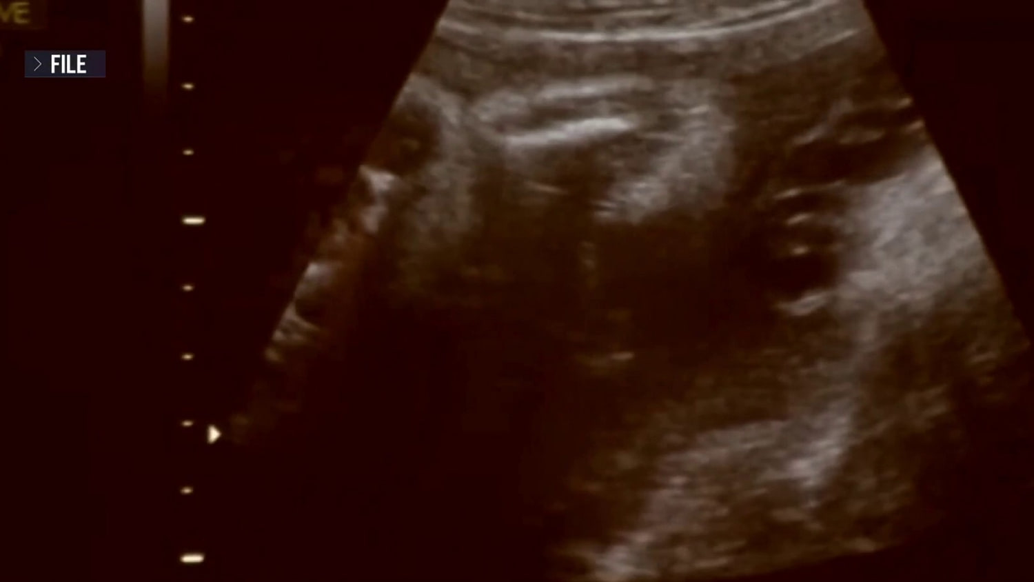 Custody battle between biological parents and surrogate