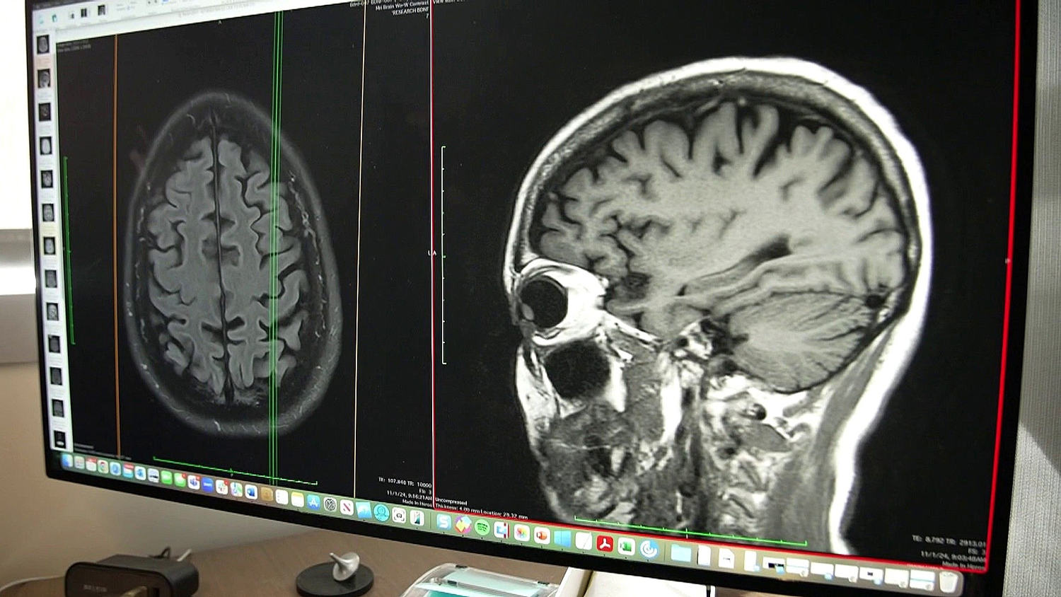 FDA Approves New Blood Test to Identify Signs of Alzheimer’s​FDA Approves New Blood Test to Identify Signs of Alzheimer’s 