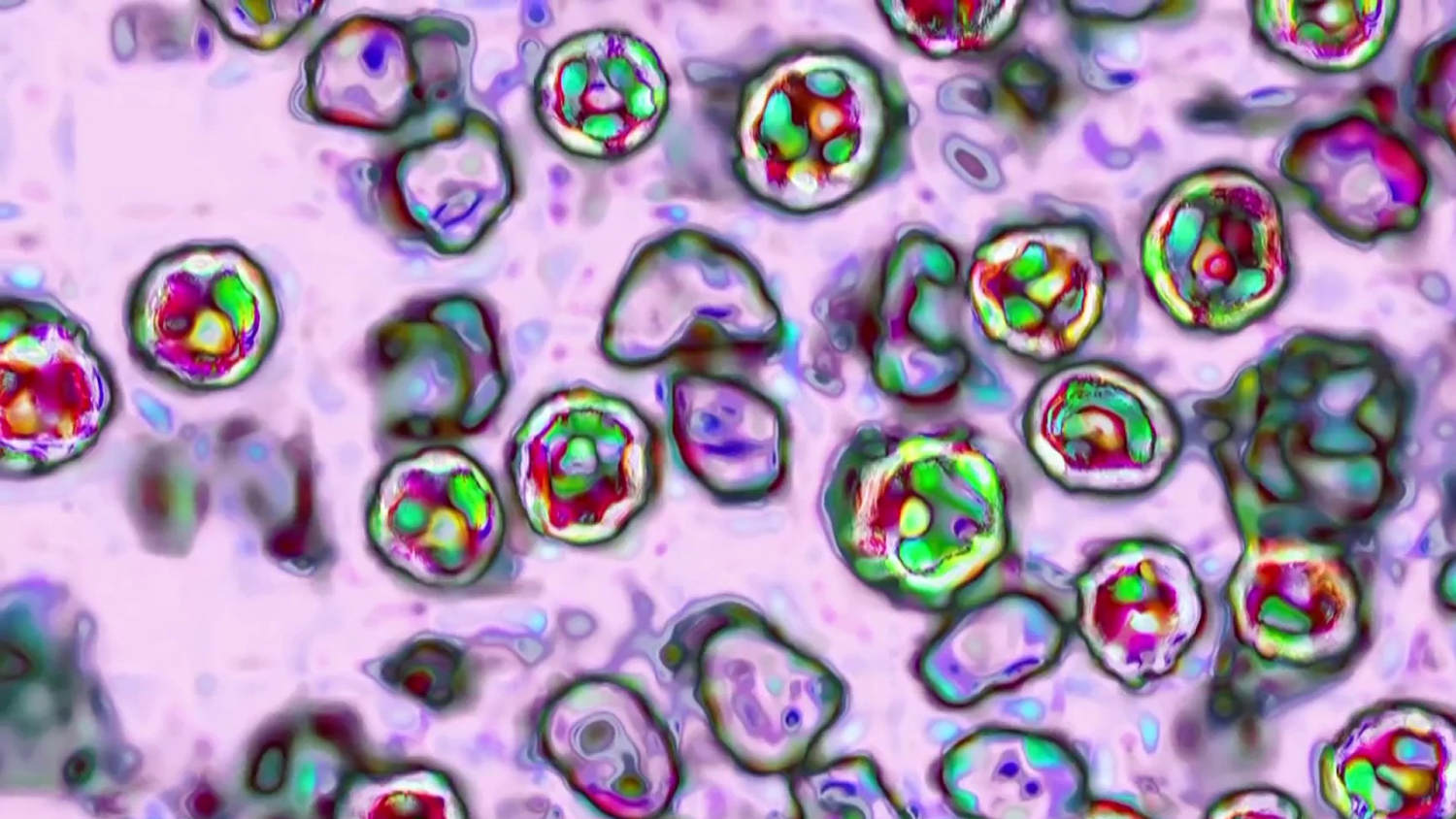Two deaths reported in Pennsylvania measles outbreak​Two deaths reported in Pennsylvania measles outbreak 